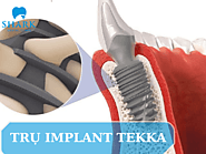 Tìm hiểu về trụ Implant Tekka chi tiết xuất xứ và giá cả