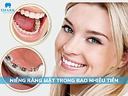 Niềng răng mặt trong bao nhiêu tiền và vì sao được ưa chuộng?