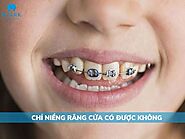 Chỉ niềng răng cửa có được không? Niềng hết bao nhiêu tiền?