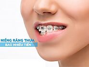 Niềng răng thưa bao nhiêu tiền? Bảng giá niềng răng thưa