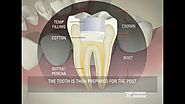 Dental Root Canal Therapy at Ashton Avenue Dental Practice
