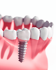 Rediscover Your Smile with Dental Implants in Auburn