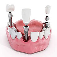 Trồng răng Implant bị đau? – Nha Khoa Home