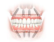 Ai nên trồng răng Implant toàn hàm All On 4? – Nha Khoa Home