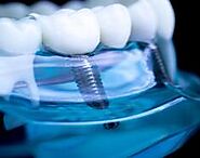 Philadelphia Dental Implant Dentist Call 267-988-4586