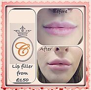 Lip Filler Prices from £150