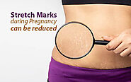 Stretch Marks and Pregnancy: Tips for Reducing Their Appearance