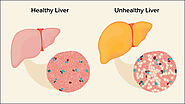 Natural Treatment of Fatty Liver with Herbs