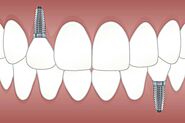 The Advancement of Teeth Replacement Technology in Dentistry – Stoma Dentals