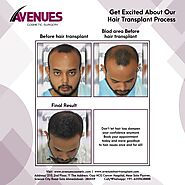 Get Best Result from Hair Transplant with Avenues