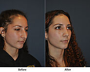 Rhinoplasty specialists in Charlotte: signs of a nose job failure