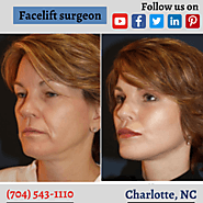 Facelift surgeon in Charlotte NC: Key things about procedures