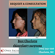 Best Charlotte rhinoplasty surgeons discuss nasal harmony
