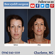 Best eyelift surgeon in Charlotte: different eye shapes procedures