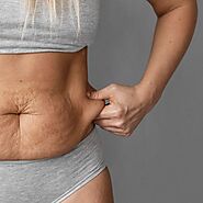 Liposuction Surgery in Pune | Liposuction Cost In Pune