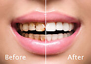 The Best Dental Clinic for Teeth Scaling And Polishing