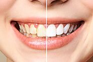 Dental Center for Teeth Whitening Near Me