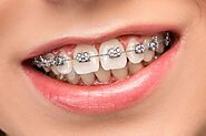 The Lowest ceramic braces cost in delhi