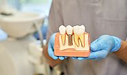 Understanding The Dental Implant Process In Alvin