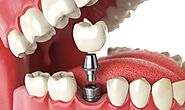 Maintaining Oral Hygiene With Dental Implants: Tips For Longevity