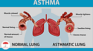 8698244 what is asthma 185px