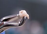 Preparing for Wisdom Tooth Extraction | Tips for a Smooth Recovery