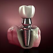 Transform Your Smile with Dental Implants in Gurgaon