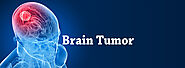 Brain Tumor Surgery in Gurgaon