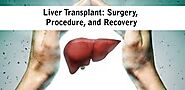 Liver Transplant: Surgery, Procedure, And Recovery