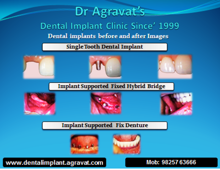 Dental Implants Ahmedabad India A Listly List