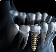 outlookdentalmckinney dental implants treatment in mckinney