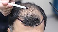 تكلفة زراعة الشعر: التفاوض مع جراحك