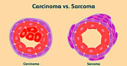 CARCINOMA AND SARCOMA: THE DIFFERENCE I Kosheeka