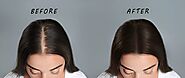 Inside a Hair Transplant: Microsurgery, Magic & the Miracle of Regrowth