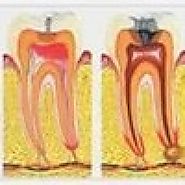 What are the Indications of Root Canal Treatment