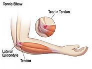 Your elbow pain may be due to tennis elbow, know more about it