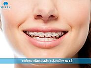 Niềng răng mắc cài sứ pha lê có tốt không? Giá bao nhiêu?