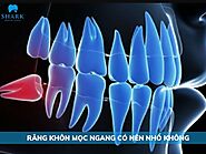 Răng khôn mọc ngang có nên nhổ không? Xử lý như thế nào?