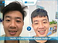 Trước và sau khi niềng răng thay đổi như thế nào?