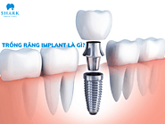 Trồng răng implant là gì? Một số điều cần biết khi thực hiện cấy imp?