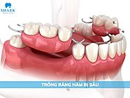 Trồng răng hàm bị sâu và những lưu ý quan trọng cần nắm