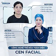 Trẻ hóa da mặt Cen Facial tại Viện Thẩm Mỹ Quốc Tế Johnson Clinic