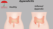 What is appendicitis?