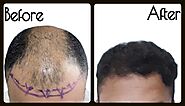 Best hair transplant cost in india
