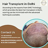 Hair Transplant In Delhi - Will Hair Transplant Leave Any Type of Scars?