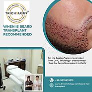 Beard Transplant in Delhi - When Is Beard Transplant Recommended