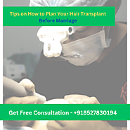 Tips on How to Plan Your Hair Transplant Before Marriage