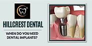 When Do You Need Dental Implants?