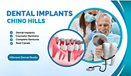 Beyond Dentures: The Advantages of Dental Implants in Chino Hills – Hillcrest Dental Studio