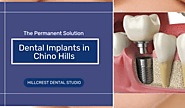 The Permanent Solution: Exploring Dental Implants in Chino Hills